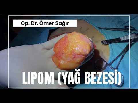 Yağ Bezesi (Lipoma) Nedir? Yağ Bezesi Nasıl Geçer?