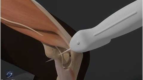 How To: Elbow Ulnar Nerve 3D Video