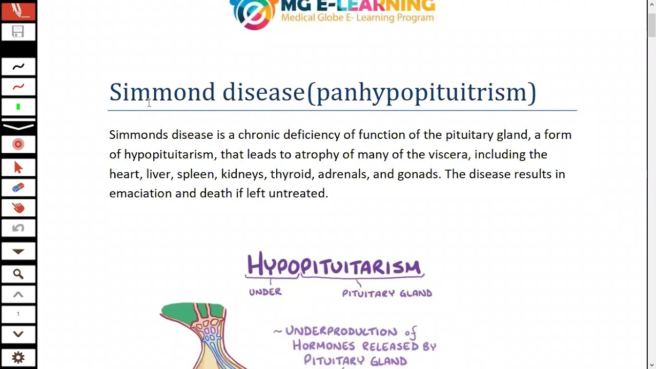 Simmond Disease Medicine Urdu/Hindi Medical Globe Elearning