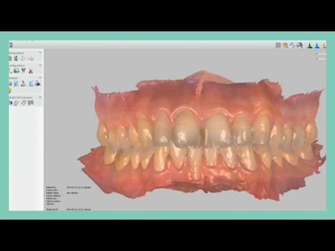 How to import STL files in Ortho Analyzer