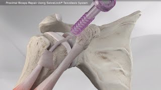 Proximal Biceps Repair Using SwiveLock® Tenodesis System