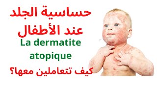 حساسية الجلد التأتبي (La dermatite atopique) الأسباب، العلاج و طرق الوقاية من الإنتكاسات #حساسيه