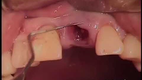 Ridge Augmentation using Osteoinductive Autologous Tooth Block and Particulate Bone