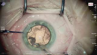 Ophthalmic surgery live 18+ Lukan Mishev