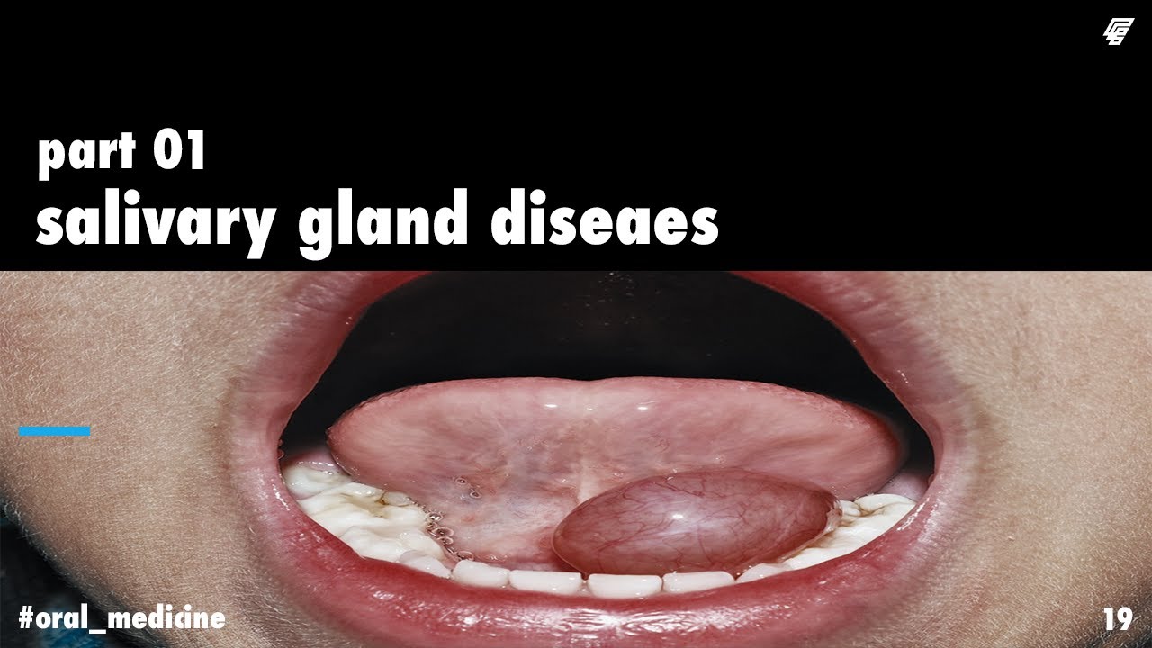 salivary gland diseases 1_ oral medicine || عزت شومان