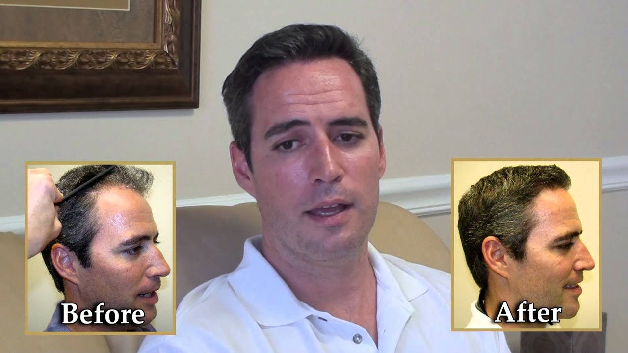Dr. Brett Bolton Great Hair Transplant