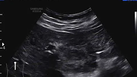 Come si toglie un angioma Rubino?