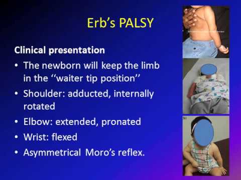 Obstetric Brachial Plexus Palsy (OBPP)/ Erb&rsquo;s Palsy