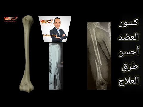 كسور عظمة العضد و الكتف ليه صعبة و ايه احسن علاج