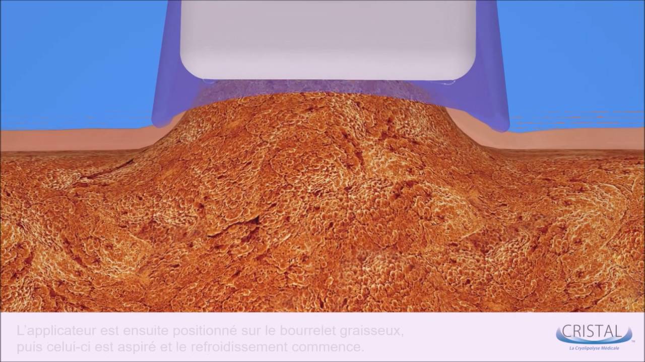 Session de Cryolipolyse Médicale CRISTAL® par Deleo : Un Aperçu Complet