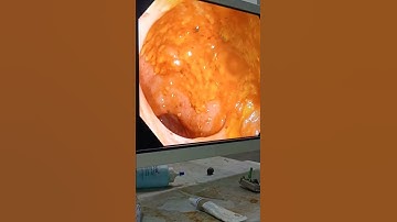 pseudomembranous colitis