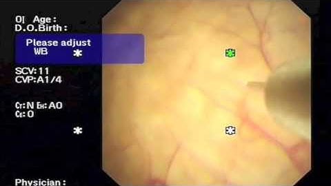 Botox therapy for Overactive Bladders