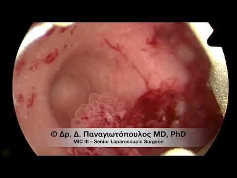 Καρκίνος Ενδομητρίου - Διαγνωστική Υστεροσκόπηση