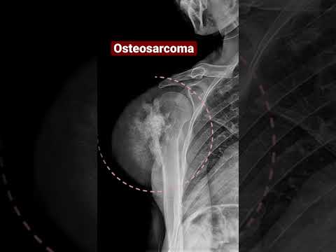 Видео: Ямар рентген шинж тэмдэг остеосаркомтай холбоотой вэ?