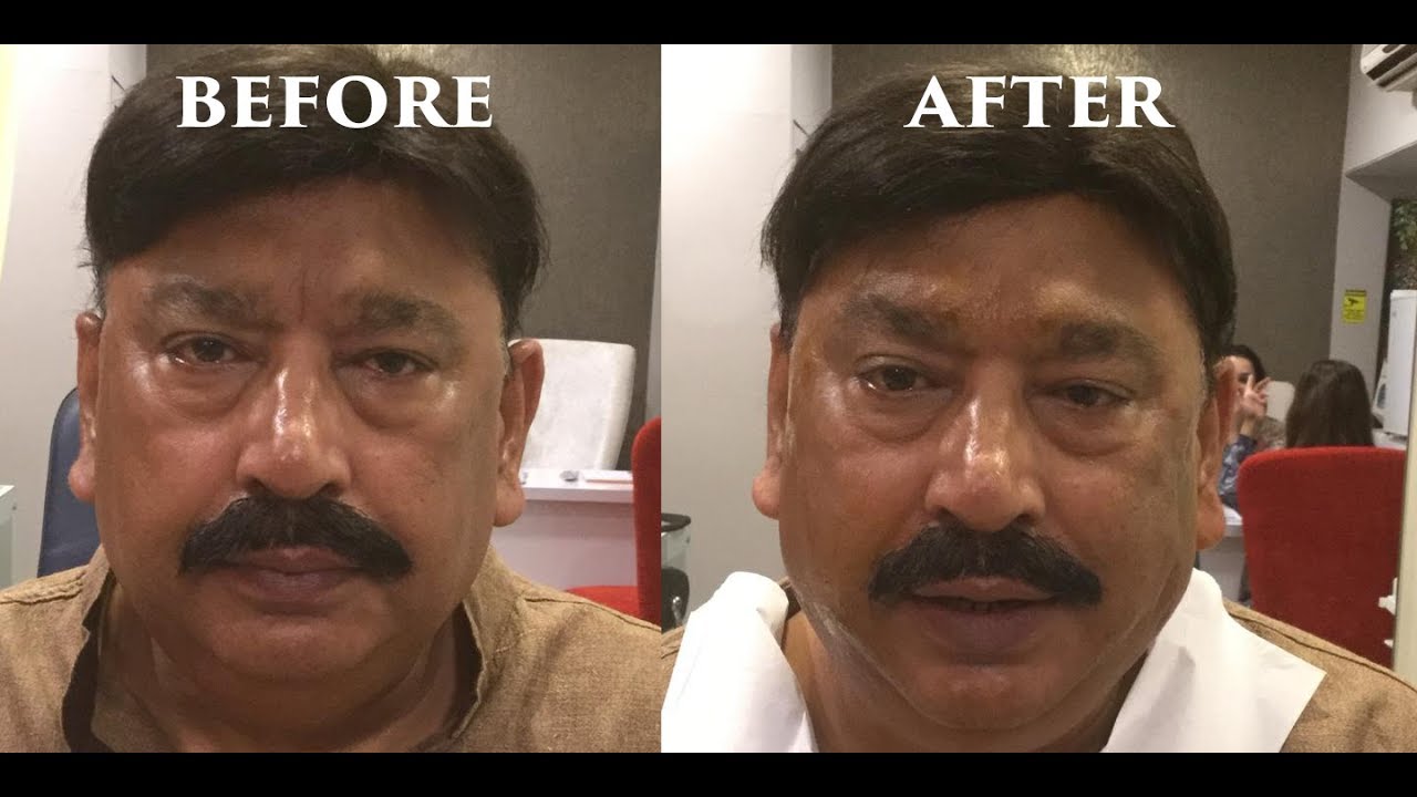 Face cog thread lift for lifting of the face. YouTube