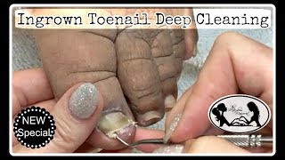 ? Pedicure at Home Deep Toe Nails Cleaning to Insure Ingrown Toenail Relief ?