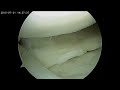 Radial meniscus tear repair  dr ankit varshney  delhi sports doc