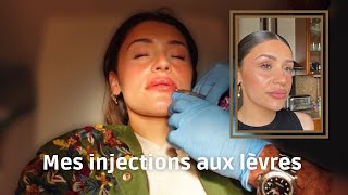 INJECTION AUX LÈVRES acide hyaluronique | Prix, Douleur, L’après