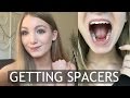 Getting Spacers for Braces! - My Experience