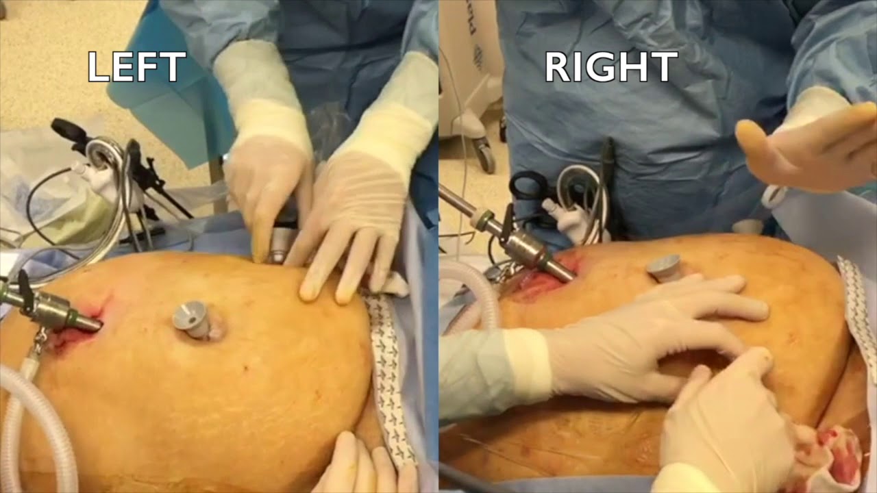 How to facilitate laparoscopy in obese oncologic patients