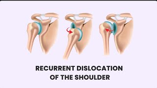 Shoulder Instability: Understanding Recurrent Dislocation