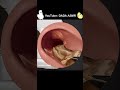 Asmr  ear cleaning and earwax removal