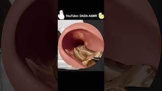 ASMR | Ear Cleaning and Earwax Removal screenshot 1