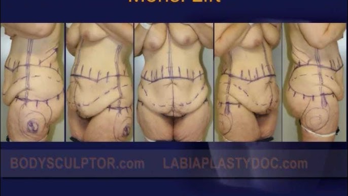 Mons Pubis Reduction Before & After Animation - Video - RealSelf