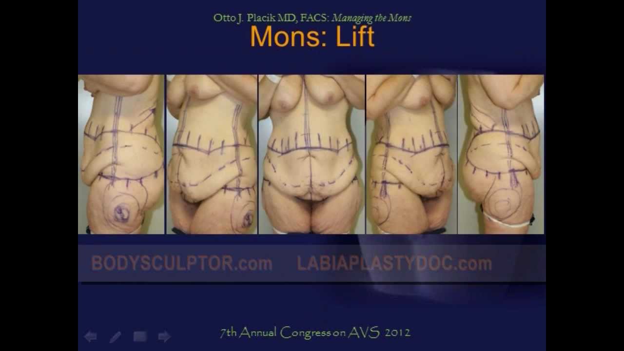 Mons Pubis Reduction & Lift Surgery by Chicago Plastic Surgeon