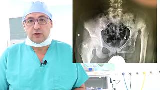  Hip Replacement Surgery - Congenital Hip Dislocation | Shaket Dabous