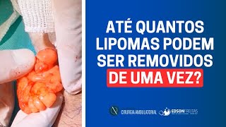 Até quantos LIPOMAS podem ser removidos DE UMA VEZ?