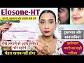 Elosone ht cream uses in hindi 2023 how to use elosone ht cream in hindi Elosone HT skin cream