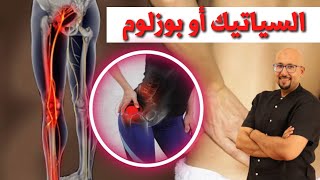 علاج التهاب العصب الوركي السياتيك بوزلوم او عرق النسا الدكتور عماد ميزاب Docteur Imad Mizab