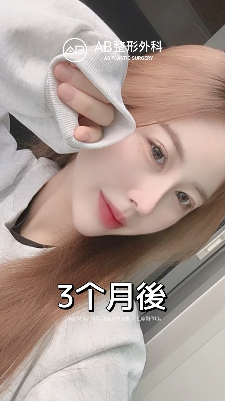 鼻整形前後對比｜自然又精緻🤍 #Shorts