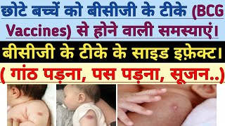 बच्चे को बीसीजी के टीके से होने वाली समस्या। गांठ, पस, सूजन। Bcg Vaccination side effects in hindi.