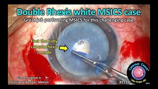 CataractCoach™ 2174: double rhexis white cataract MSICS