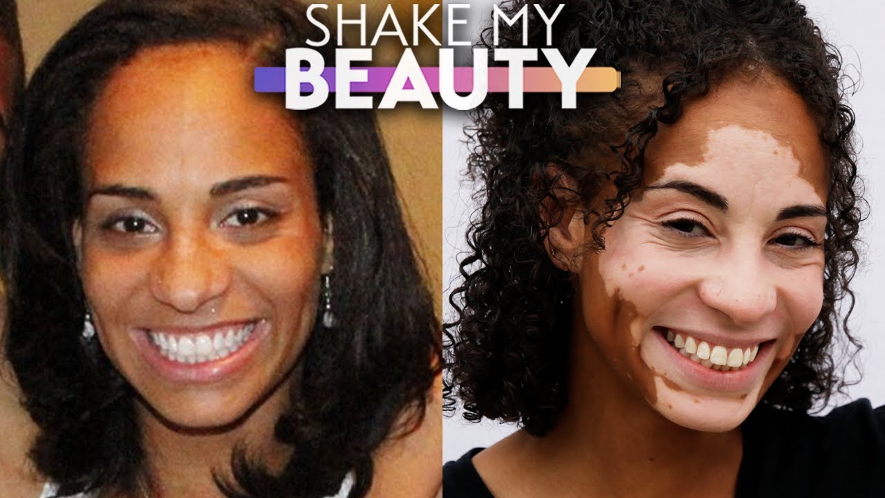My Skin Condition Made Me Cry - Now I Inspire Others | SHAKE MY BEAUTY