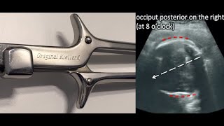 Seeing is believing!! Kielland&#39;s Forceps Rotation under Ultrasound.