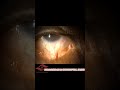 #symblepharon#pathologic#bulbar#palpebral#conjunctiva#abnormal#cryptophthalmos#short#trending#reels