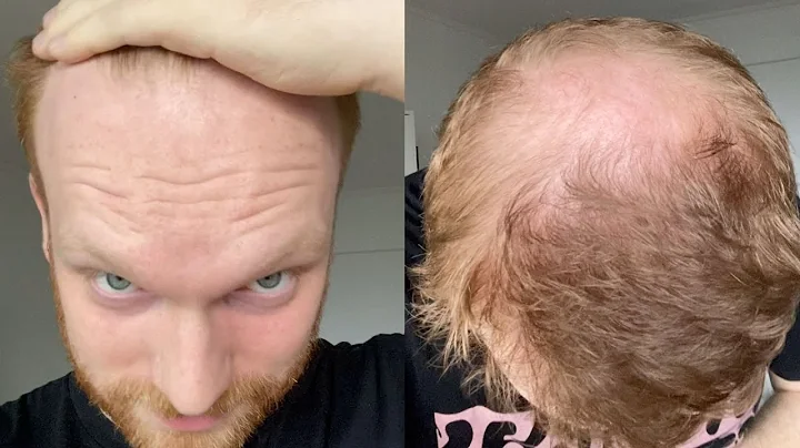 Going Bald In My Early 20's - How I Accepted Balding