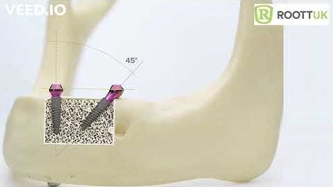 ROOTT R multi-unit upto 45 degrees