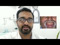 RECEDING GUMS- causes and treatment | masudo ka niche chale Jana