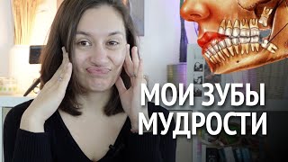 удаляю ЗУБЫ МУДРОСТИ | как мне выдергивали восьмерки | мой опыт