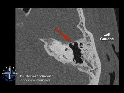 Otosclerosis Revision Surgery Epitympanic Malleus Ankylosis - Malleus To Stapedotomy  (TORP)