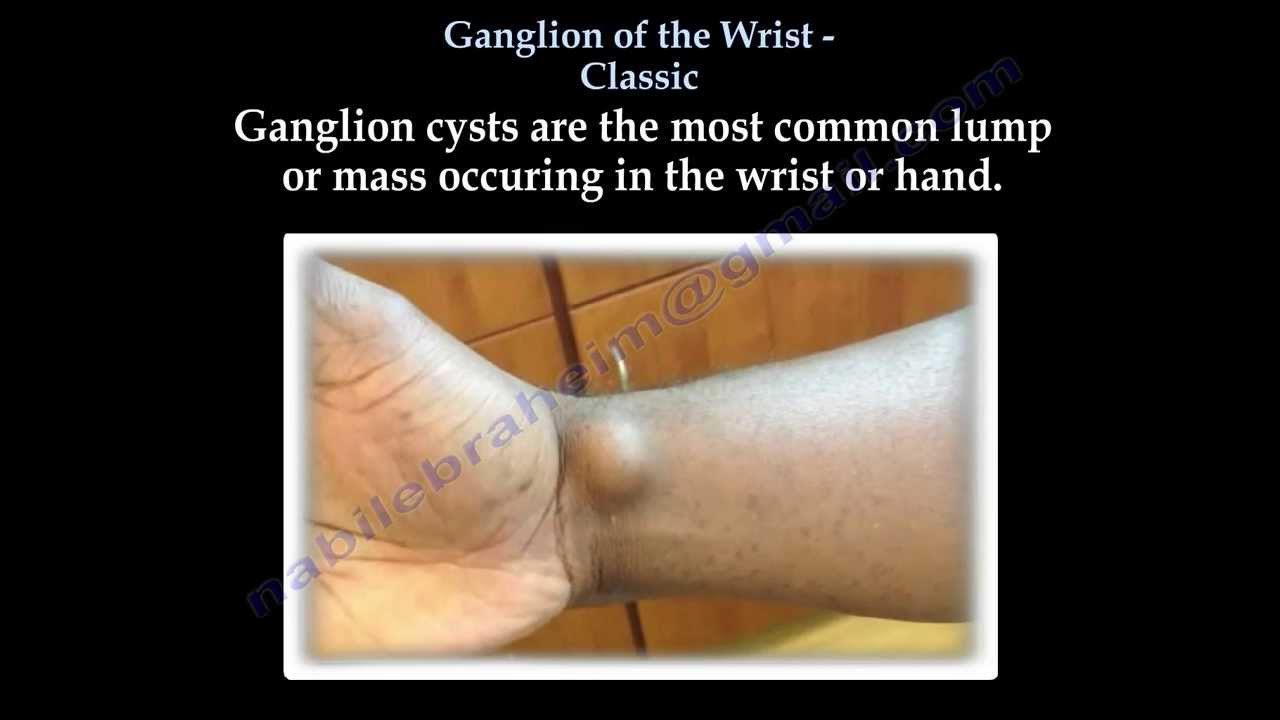 Ganglion Cyst Of The Wrist Classic Everything You Need To Know Dr Nabil Ebraheim Youtube