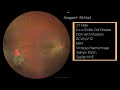 Sea fans under the knife: Vitrectomy for Proliferative Sickle Retinopathy