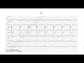 EKG in 3 Minuten [10]