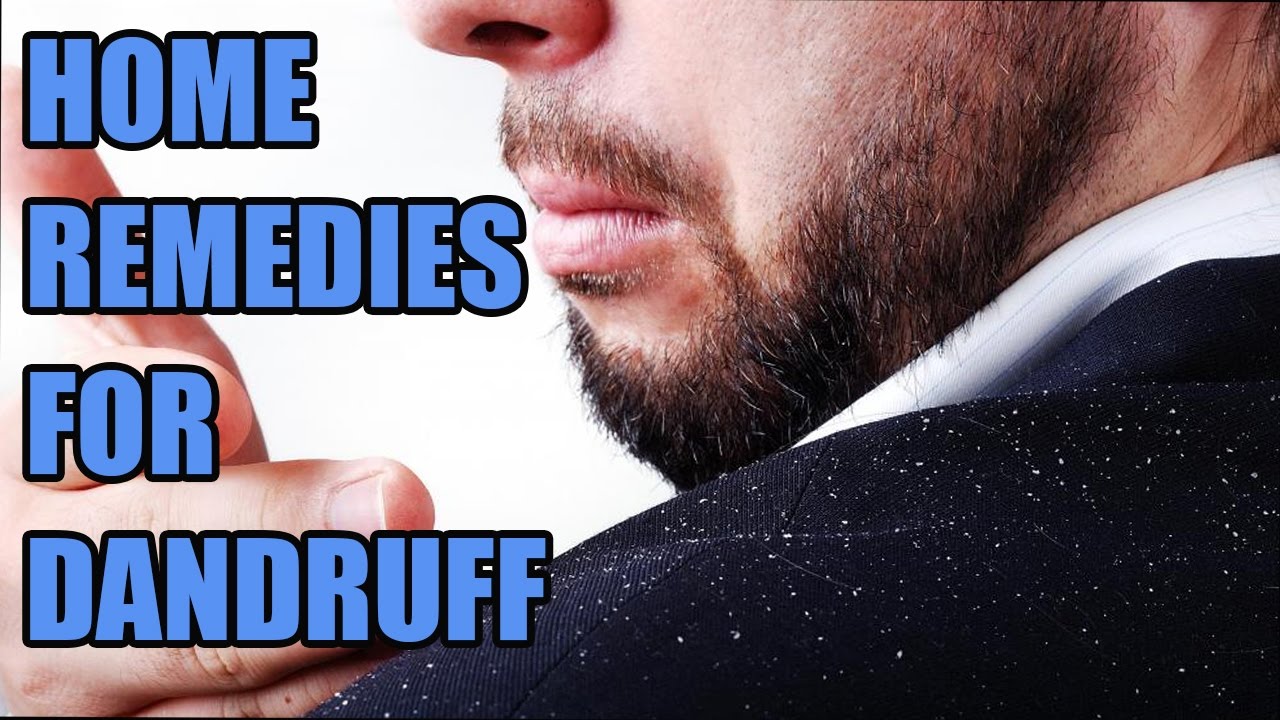How to Cure Dandruff Naturally | Home Remedies for Dandruff | Get Rid of Dandruff Fast - YouTube