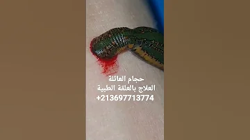 العلاج بالعلقة الطبية دودة العلق 