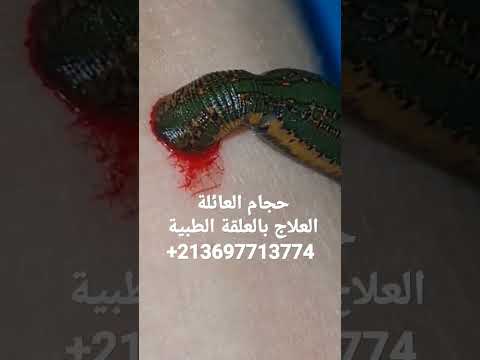 العلاج بالعلقة الطبية دودة العلق